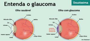 glaucoma