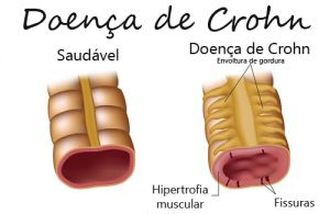 crohn